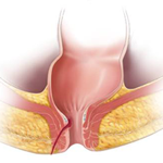 Anal fistula