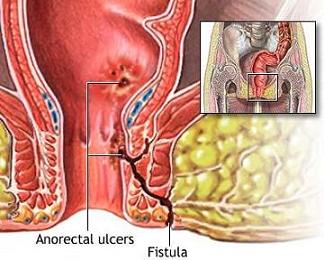 fistula