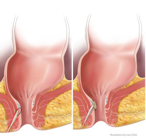 Fistula